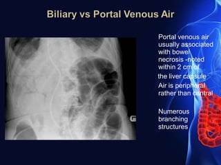 Portal venous air
usually associated
with bowel
necrosis -noted
within 2 cm of
the liver capsule
Air is peripheral
rather than central
Numerous
branching
structures
 
