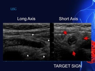 Long Axis Short Axis
TARGET SIGN
USG
 