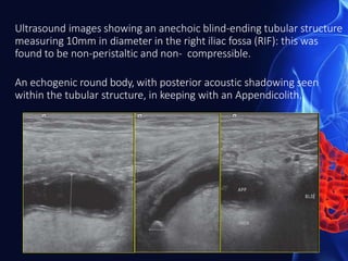 Ultrasound images showing an anechoic blind-ending tubular structure
measuring 10mm in diameter in the right iliac fossa (RIF): this was
found to be non-peristaltic and non- compressible.
An echogenic round body, with posterior acoustic shadowing seen
within the tubular structure, in keeping with an Appendicolith.
 