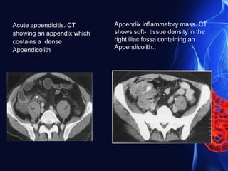 Acute appendicitis. CT
showing an appendix which
contains a dense
Appendicolith
Appendix inflammatory mass. CT
shows soft- tissue density in the
right iliac fossa containing an
Appendicolith..
 
