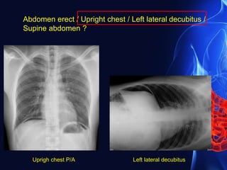 Abdomen erect / Upright chest / Left lateral decubitus /
Supine abdomen ?
Uprigh chest P/A Left lateral decubitus
 