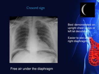 Free air under the diaphragm
Best demonstrated on
upright chest x rays or
left lat decubitus
Easier to see under
right diaphragm
Crescent sign
 