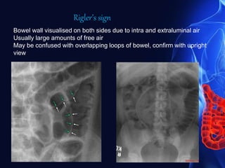 Bowel wall visualised on both sides due to intra and extraluminal air
Usually large amounts of free air
May be confused with overlapping loops of bowel, confirm with upright
view
Rigler’s sign
 