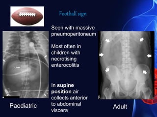 Seen with massive
pneumoperitoneum
Most often in
children with
necrotising
enterocolitis
Paediatric Adult
In supine
position air
collects anterior
to abdominal
viscera
Football sign
 