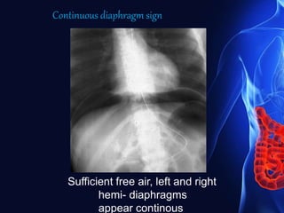 Sufficient free air, left and right
hemi- diaphragms
appear continous
Continuous diaphragm sign
 