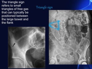 The triangle sign
refers to small
triangles of free gas
that can typically be
positioned between
the large bowel and
the flank
Triangle sign
 