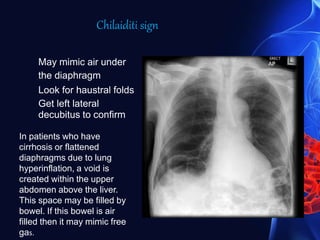 May mimic air under
the diaphragm
Look for haustral folds
Get left lateral
decubitus to confirm
In patients who have
cirrhosis or flattened
diaphragms due to lung
hyperinflation, a void is
created within the upper
abdomen above the liver.
This space may be filled by
bowel. If this bowel is air
filled then it may mimic free
gas.
Chilaiditi sign
 