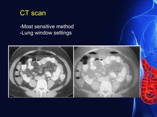 CT scan
-Most sensitive method
-Lung window settings
 
