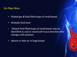 On Plain films
• Dilated gas & fluid filled loops of small bowel.
• Multiple fluid level
• Dilated fluid-filled loops of small bowel may be
identified as oval or round soft tissue densities that
changes with position.
• Absent or little air in large bowel
 