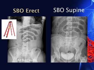 SBO Supine
Air fluid levels
 