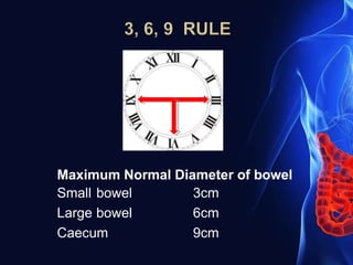 Maximum Normal Diameter of bowel
Small bowel
Large bowel
Caecum
3cm
6cm
9cm
 