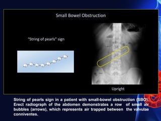 String of pearls sign in a patient with small-bowel obstruction (SBO).
Erect radiograph of the abdomen demonstrates a row of small air
bubbles (arrows), which represents air trapped between the valvulae
conniventes.
 