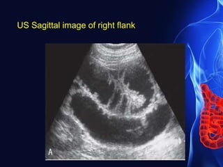 US Sagittal image of right flank
 
