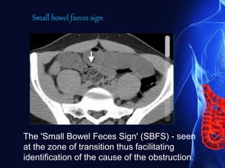 The 'Small Bowel Feces Sign' (SBFS) - seen
at the zone of transition thus facilitating
identification of the cause of the obstruction.
Small bowel faeces sign
 