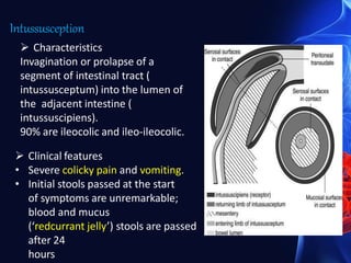 Intussusception
 Characteristics
Invagination or prolapse of a
segment of intestinal tract (
intussusceptum) into the lumen of
the adjacent intestine (
intussuscipiens).
90% are ileocolic and ileo-ileocolic.
 Clinical features
• Severe colicky pain and vomiting.
• Initial stools passed at the start
of symptoms are unremarkable;
blood and mucus
(‘redcurrant jelly’) stools are passed
after 24
hours
 