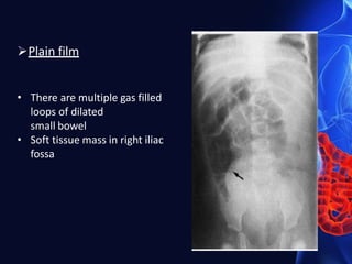 Plain film
• There are multiple gas filled
loops of dilated
small bowel
• Soft tissue mass in right iliac
fossa
 