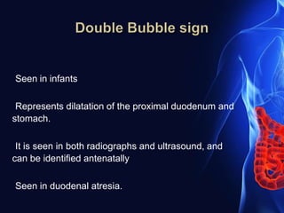 Seen in infants
Represents dilatation of the proximal duodenum and
stomach.
It is seen in both radiographs and ultrasound, and
can be identified antenatally
Seen in duodenal atresia.
 