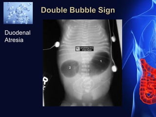 Duodenal
Atresia
 