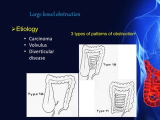 Largebowelobstruction
Etiology
• Carcinoma
• Volvulus
• Diverticular
disease
3 types of patterns of obstruction
 