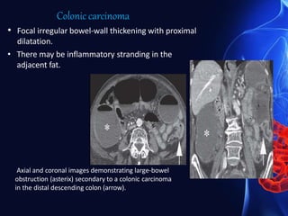Colonic carcinoma
• Focal irregular bowel-wall thickening with proximal
dilatation.
• There may be inflammatory stranding in the
adjacent fat.
Axial and coronal images demonstrating large-bowel
obstruction (asterix) secondary to a colonic carcinoma
in the distal descending colon (arrow).
 