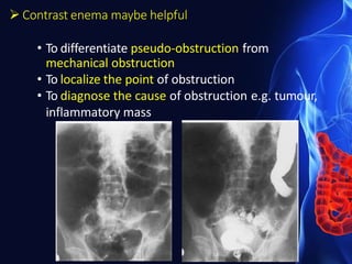  Contrast enema maybe helpful
• To differentiate pseudo-obstruction from
mechanical obstruction
• To localize the point of obstruction
• To diagnose the cause of obstruction e.g. tumour,
inflammatory mass
 