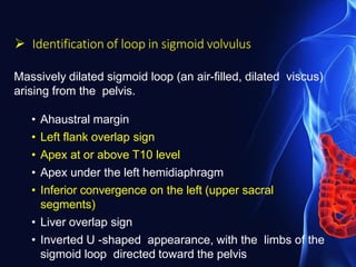  Identification of loop in sigmoid volvulus
Massively dilated sigmoid loop (an air-filled, dilated viscus)
arising from the pelvis.
• Ahaustral margin
• Left flank overlap sign
• Apex at or above T10 level
• Apex under the left hemidiaphragm
• Inferior convergence on the left (upper sacral
segments)
• Liver overlap sign
• Inverted U -shaped appearance, with the limbs of the
sigmoid loop directed toward the pelvis
 