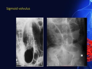 Sigmoid volvulus
 