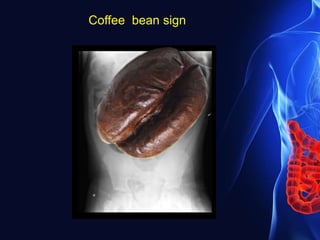 Coffee bean sign
 