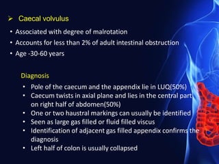 Caecal volvulus
• Associated with degree of malrotation
• Accounts for less than 2% of adult intestinal obstruction
• Age -30-60 years
Diagnosis
• Pole of the caecum and the appendix lie in LUQ(50%)
• Caecum twists in axial plane and lies in the central part
on right half of abdomen(50%)
• One or two haustral markings can usually be identified
• Seen as large gas filled or fluid filled viscus
• Identification of adjacent gas filled appendix confirms the
diagnosis
• Left half of colon is usually collapsed
 