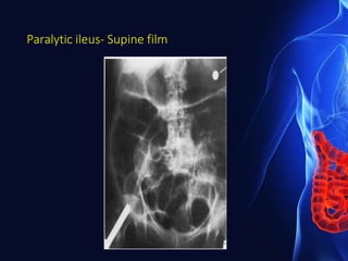 Paralytic ileus- Supine film
 