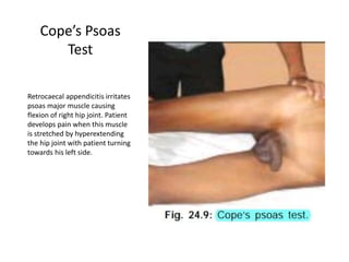 Cope’s Psoas
Test
Retrocaecal appendicitis irritates
psoas major muscle causing
flexion of right hip joint. Patient
develops pain when this muscle
is stretched by hyperextending
the hip joint with patient turning
towards his left side.
 
