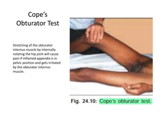 Cope’s
Obturator Test
Stretching of the obturator
internus muscle by internally
rotating the hip joint will cause
pain if inflamed appendix is in
pelvic position and gets irritated
by the obturator internus
muscle.
 