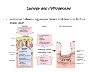 Etiology and Pathogenesis
• Imbalance between aggressive factors and defensive factors
cause ulcer
 
