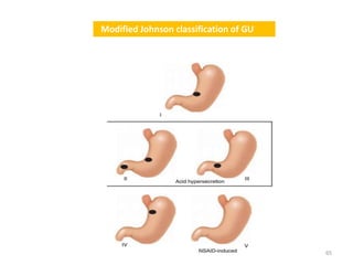 65
Modified Johnson classification of GU
 