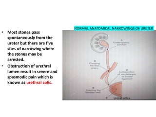 • Most stones pass
spontaneously from the
ureter but there are five
sites of narrowing where
the stones may be
arrested.
• Obstruction of urethral
lumen result in severe and
spasmodic pain which is
known as urethral colic.
NORMAL ANATOMICAL NARROWINGS OF URETER
Uretral orifice
 