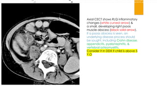 ULTTASOUND FOR ACUTE ABDOMEN IN EMERGENCY .pptx