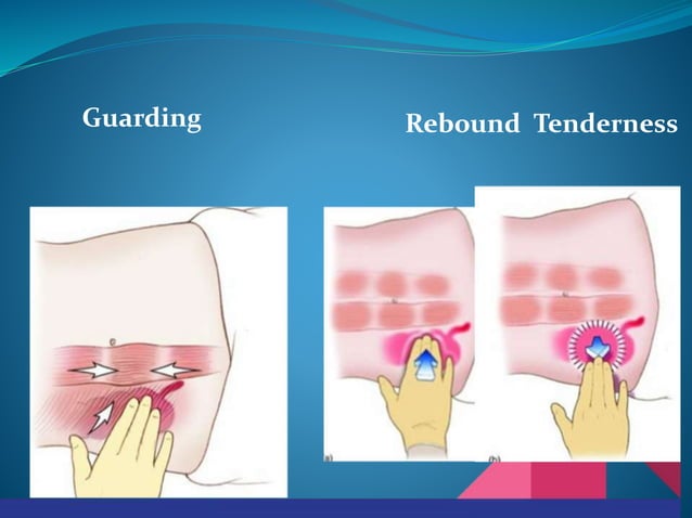 Acute Abdomen .pptx