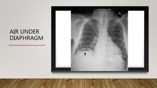 AIR UNDER
DIAPHRAGM
 