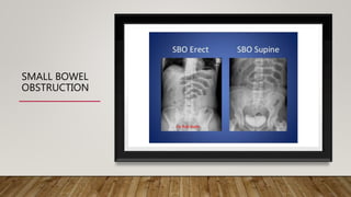 SMALL BOWEL
OBSTRUCTION
 