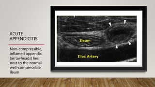 ACUTE
APPENDICITIS
Non-compressible,
inflamed appendix
(arrowheads) lies
next to the normal
well-compressible
ileum
 