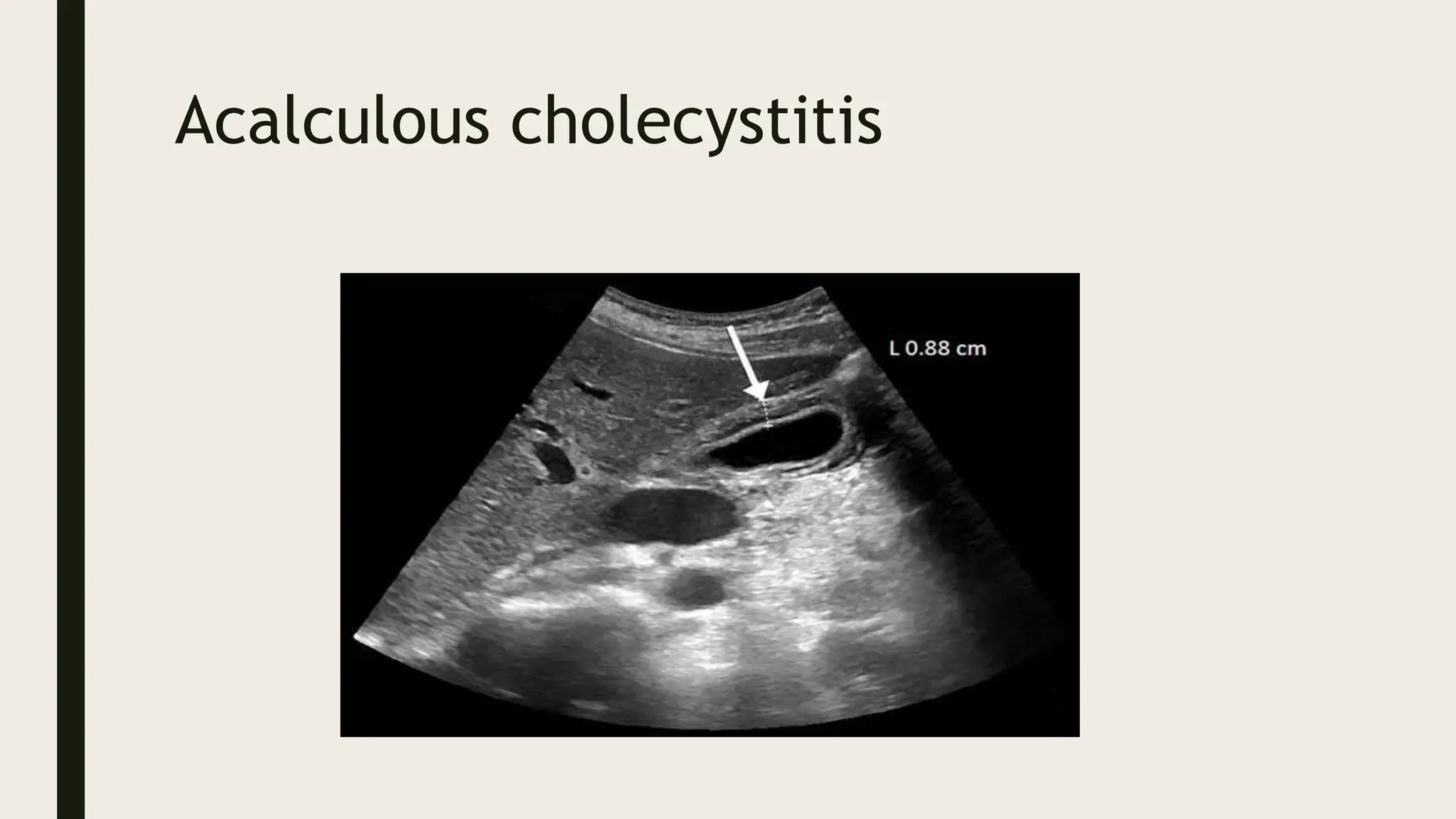 Acute Abdomen Imaging 2 Pptxacute Abdomen Imaging 2 Pptxacute Abdomen