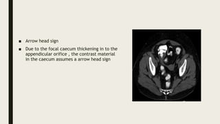 ACUTE ABDOMEN IMAGING 2.pptxACUTE ABDOMEN IMAGING 2.pptxACUTE ABDOMEN ...