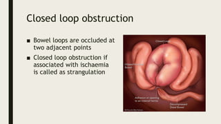 What Is Constriction Loop ACUTE ABDOMEN IMAGING 2.pptxACUTE ABDOMEN IMAGING 2.pptxACUTE ABDOMEN ...