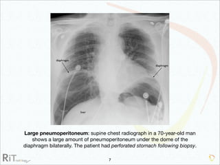 Imaging Acute Abdomen (Part 1)