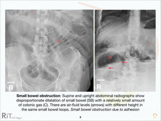 Imaging Acute Abdomen (Part 1)