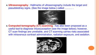 4. Ultrasonography : Hallmarks of ultrasonography include the target and
pseudokidney signs. (See the image below.) called ……… .
4. Computed tomography (CT) scanning : has also been proposed as a
useful tool to diagnose intussusception (see the image below); however,
CT scan findings are unreliable, and CT scanning carries risks associated
with intravenous contrast administration, radiation exposure, and sedation.
 