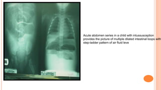 Acute abdomen series in a child with intussusception
provides the picture of multiple dilated intestinal loops with
step-ladder pattern of air fluid leve
 