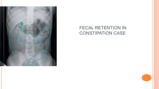 FECAL RETENTION IN
CONSTIPATION CASE
 
