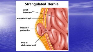 Acute Abdomen Intestinal Obstruction Peritonitis.pptx