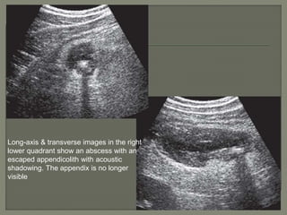 ACUTE ABDOMEN SONOGRAPHIC FINDINGS ppt | PPTX